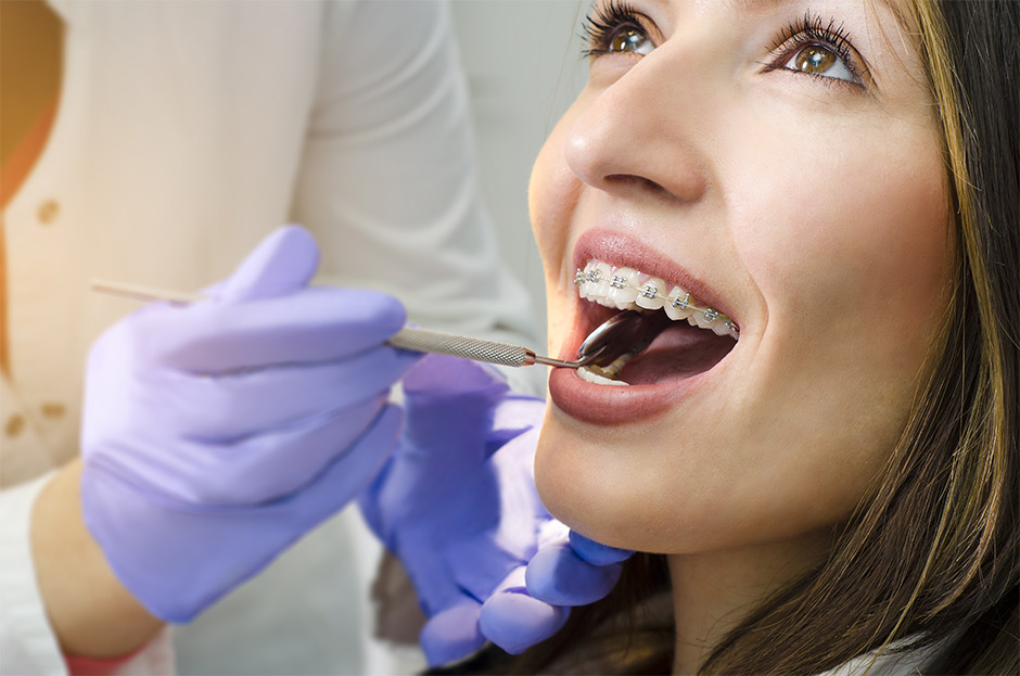 Read more about the article Aparelhos para os dentes: qual, quando e como usar