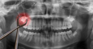 Read more about the article 10 perguntas e respostas sobre o dente do siso