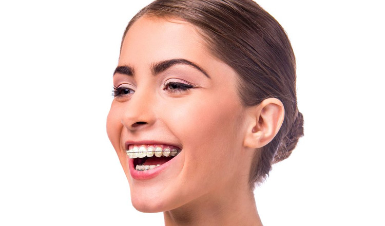 Read more about the article Dentes mais alinhados podem melhorar a saúde bucal