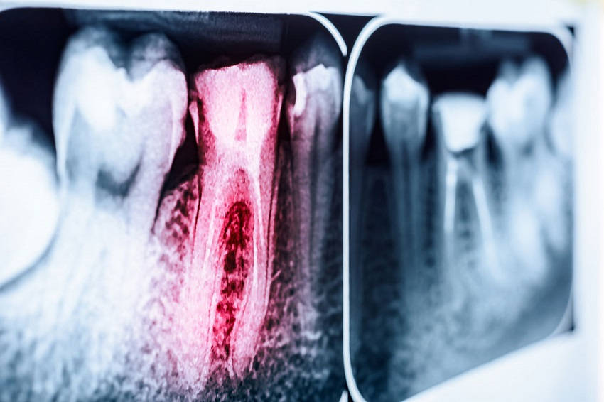 Read more about the article Dentes perdidos: e quando nem o tratamento de canal consegue solucionar o problema?