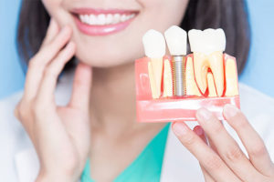 Read more about the article Funcionamento do implante dentário e cuidados que ele demanda